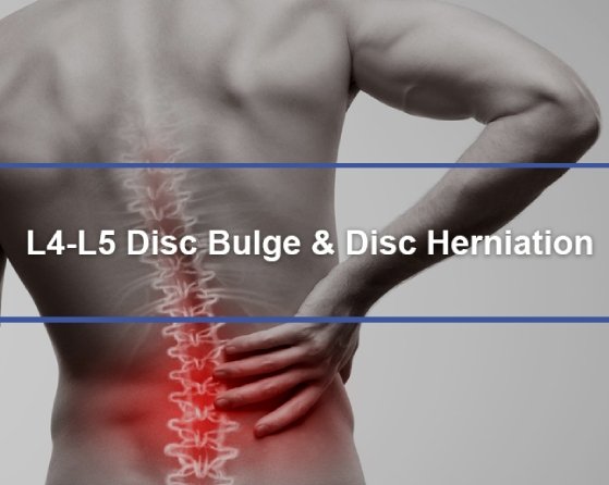 Understanding L L Disc Bulge Herniation Alleviatepainclinic