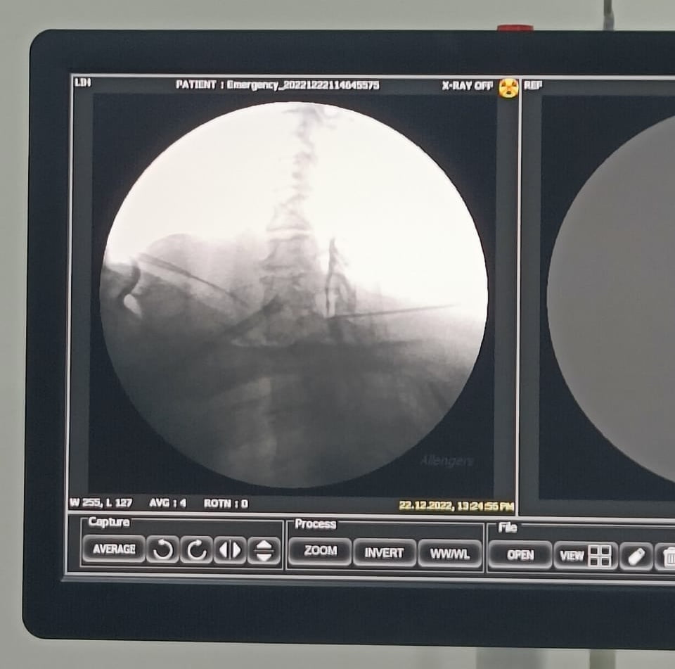 Cervical Epidural Injection A Comprehensive Guide To Understanding And