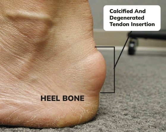 10 Effective Home Remedies to Treat Achilles Tendon Pain - InSync  Physiotherapy