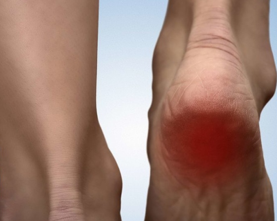 Heel Pain: Causes, Treatment, and When to See a Doctor
