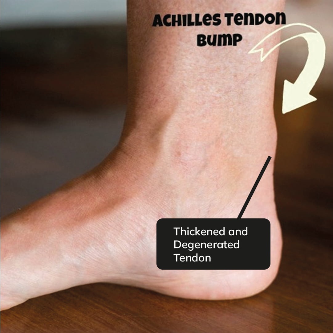 achilles-tendonitis-treatment-for-heel-pain-and-symptoms-alleviate