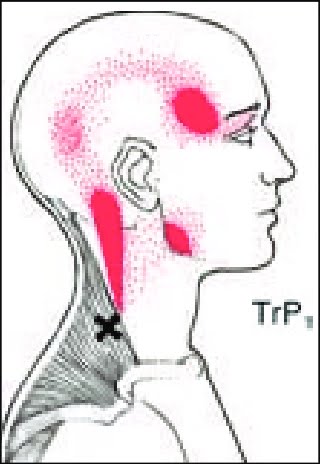 Trigger Points Causing Neck and Shoulder Pain: A Comprehensive Analysis