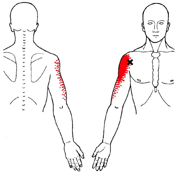 Trigger Points Causing Neck and Shoulder Pain: A Comprehensive Analysis