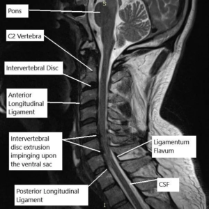 C5-C6 Disc Bulge: Causes, Symptoms, Role of MRI, and Treatment without ...