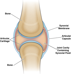 Cartilage Loss/Joint Space Narrowing