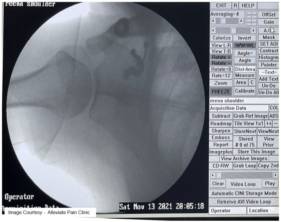 Treating Frozen Shoulder & Range-of-Motion Shoulder Injuries — RS Medical