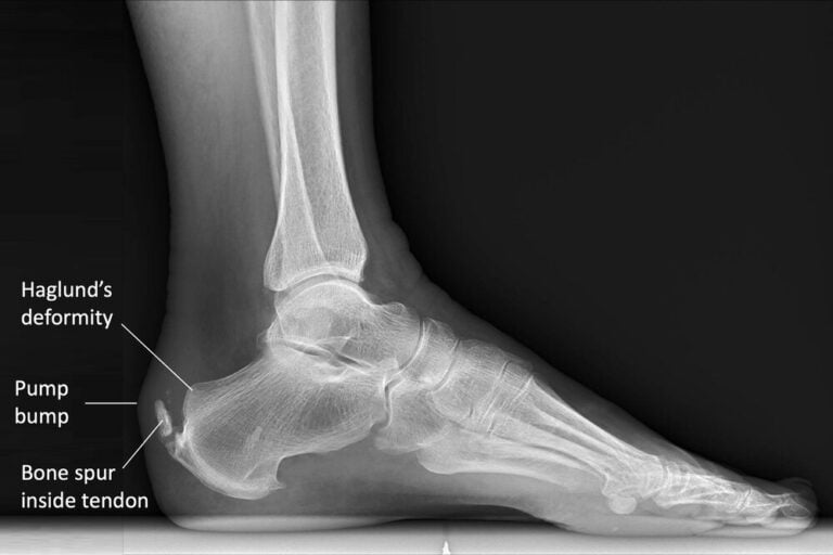 Achilles Tendonitis: Causes, Pathology, Imaging, and Treatment ...