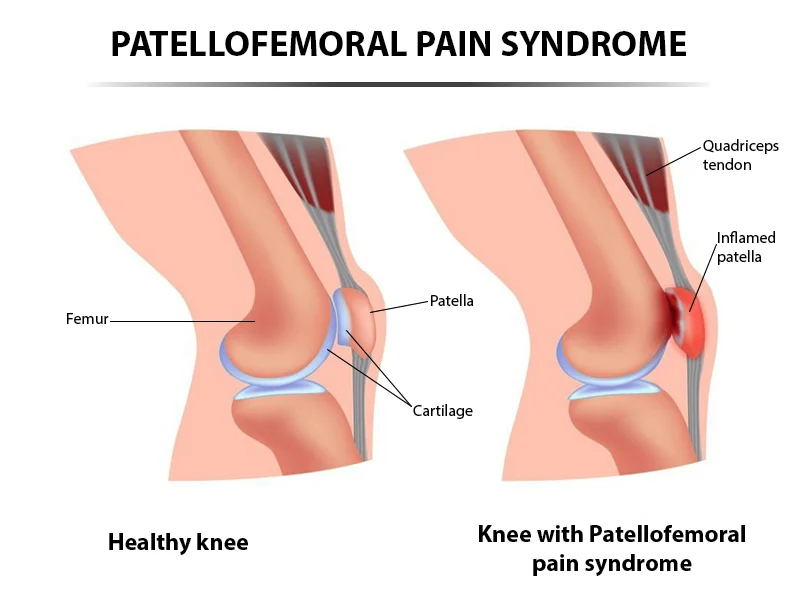 Anatomy of Patellofemoral Pain Syndrome.jpg