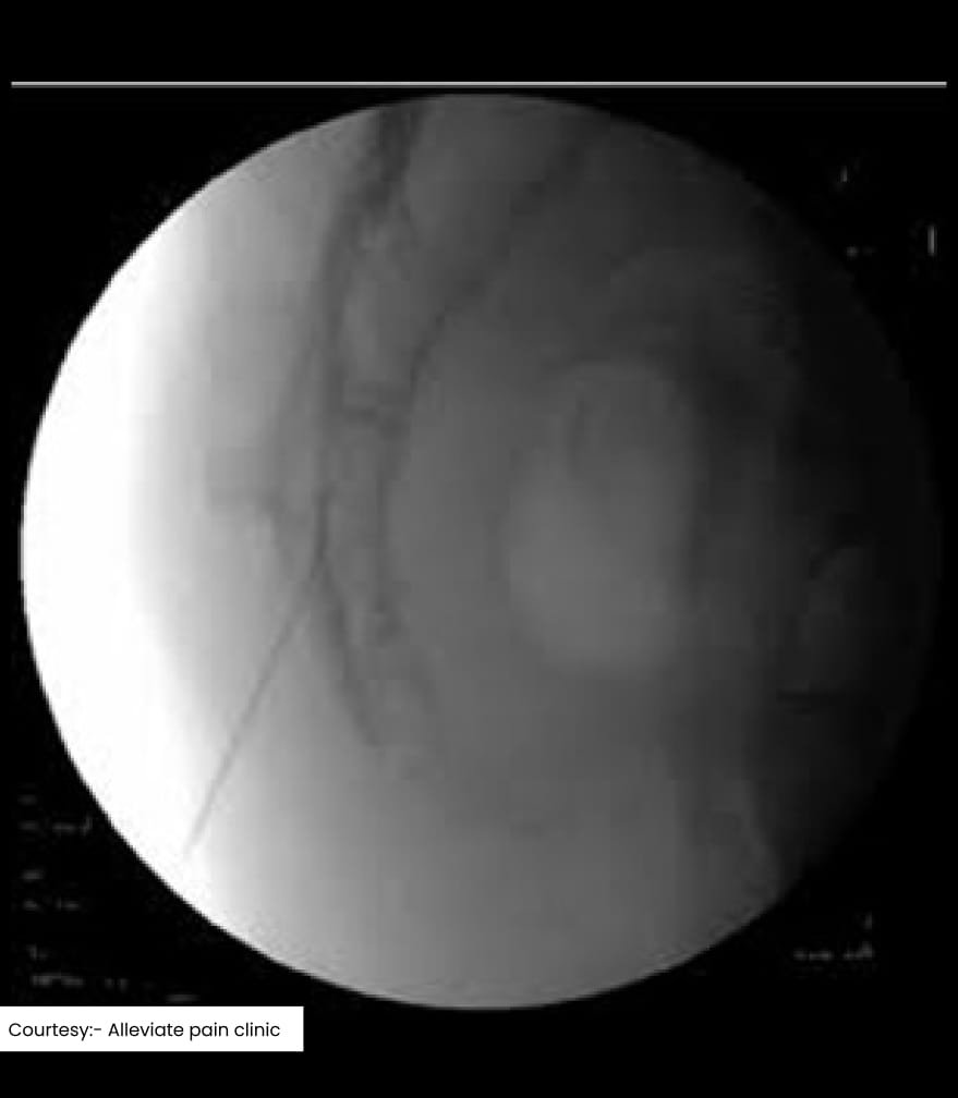 Caudal Epidural injection image 1