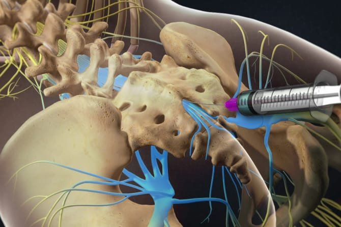 Caudal Epidural injection blog thumbnail