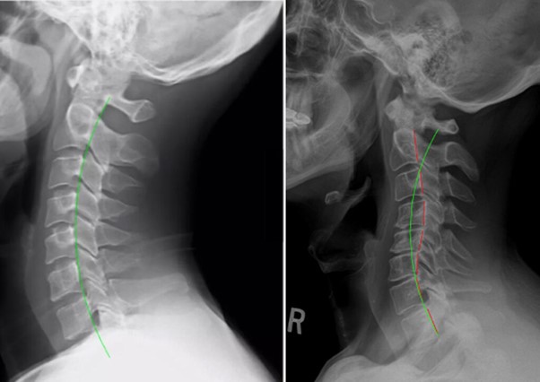 Left-Sided Neck Pain: 12 Common Causes and Treatment Options