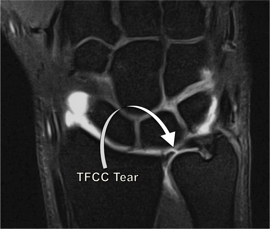 MRI of the wrist showing a TFCC tear