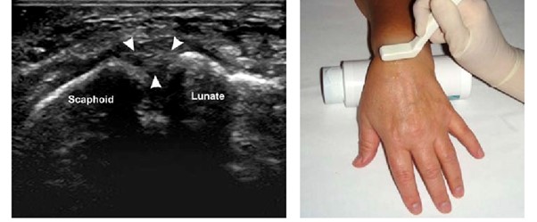 Diagnostic Ultrasound showing the TFCC ligament