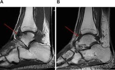 Fibrosis from Old Injuries