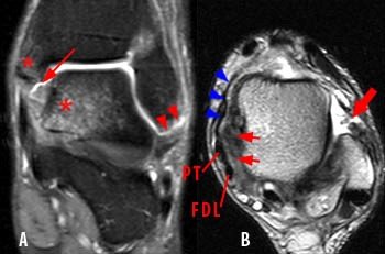 mri ankle