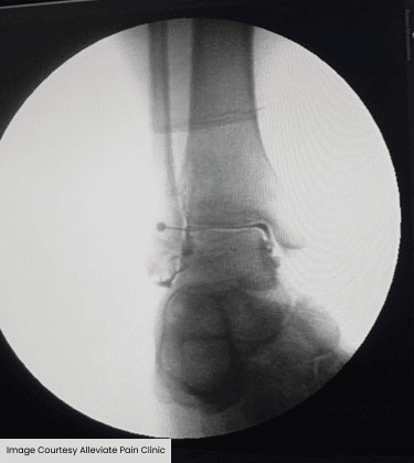 scan ankle