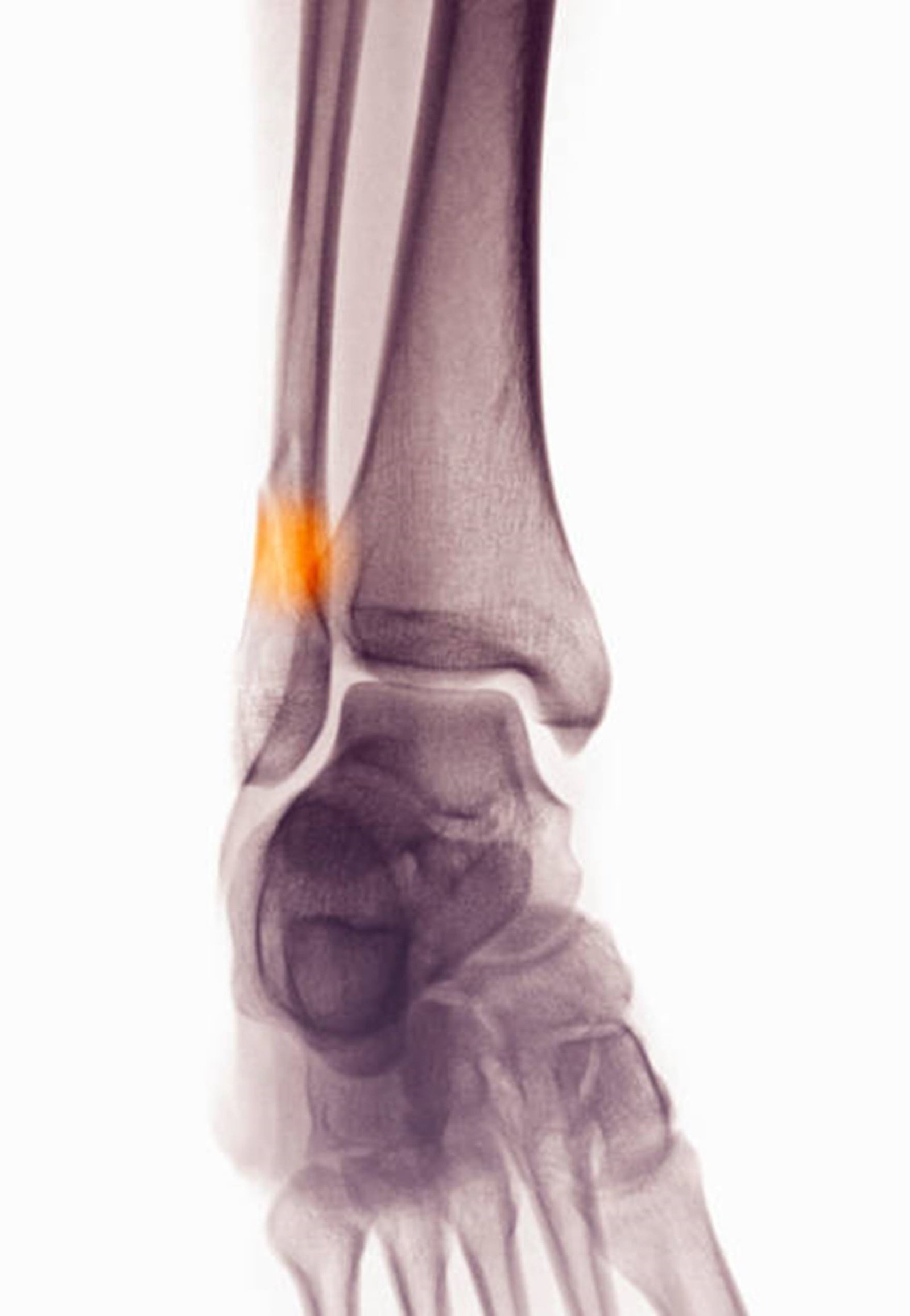 xray ankle