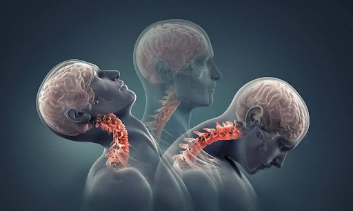 Cervical spine instability with excessive neck movement and loose ligaments
