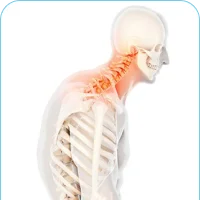 Kyphosis