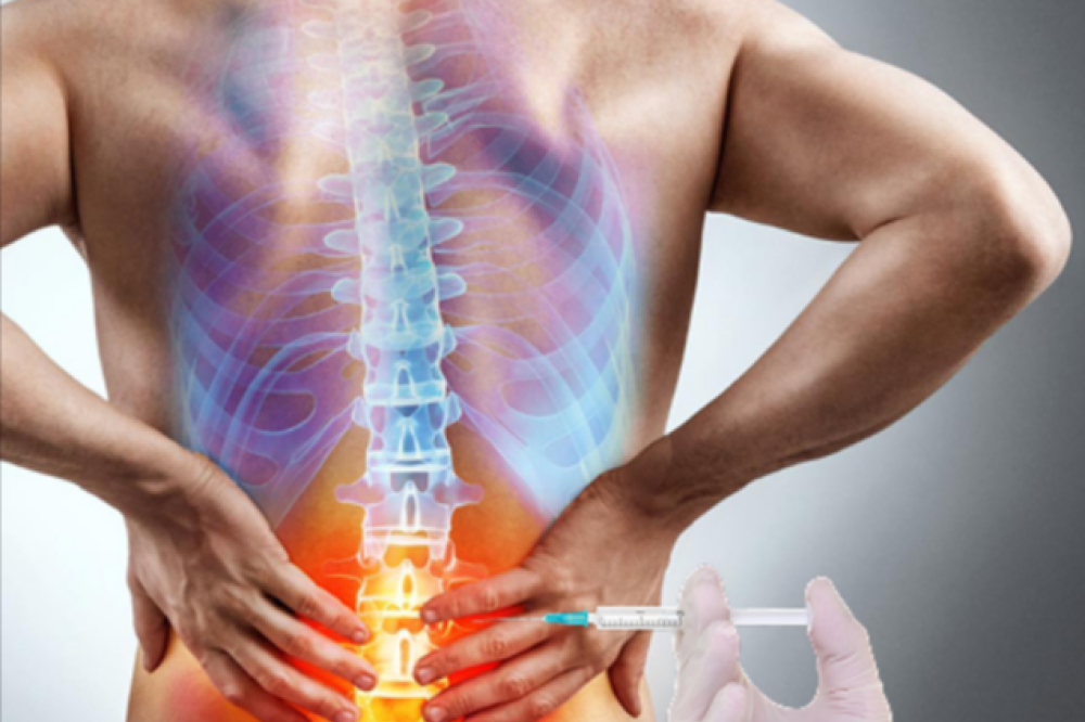 PRP Treatment for Back Pain