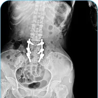 Post Laminectomy Syndrome