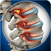 Spinal Stenosis