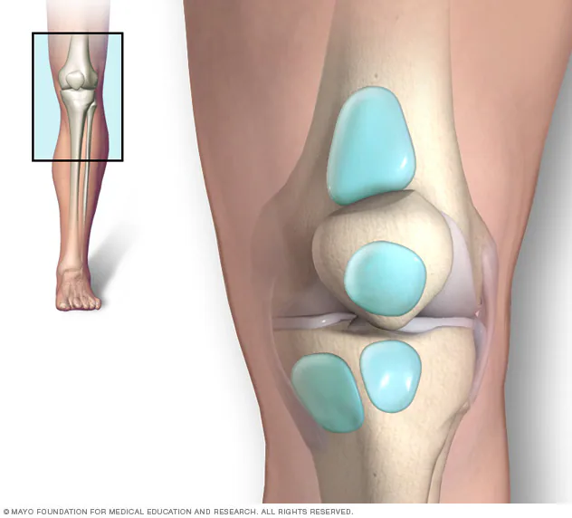 Knee Bursitis