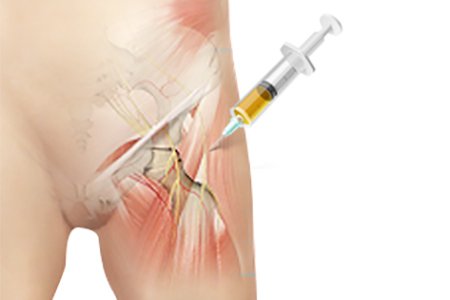 PRP (Platelet Rich Plasma Therapy)