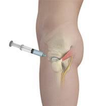 Prolotherapy (1)