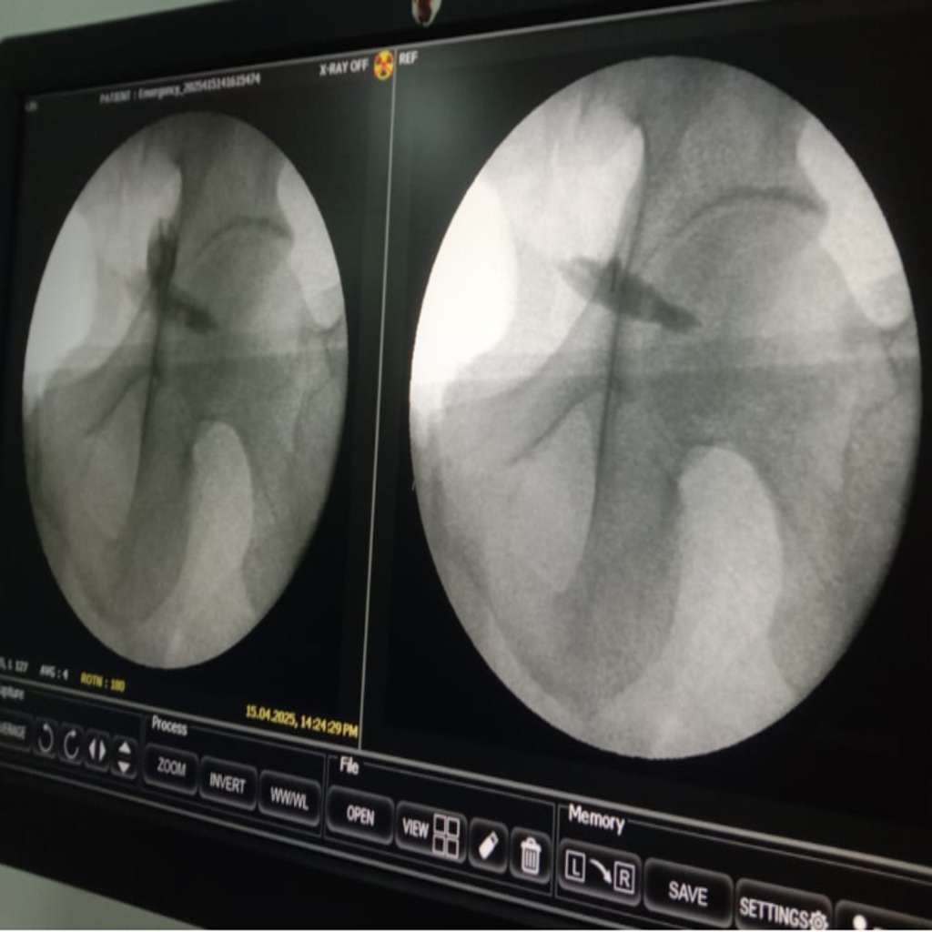 Fluoroscopy guided Injection for Piriformis Syndrome