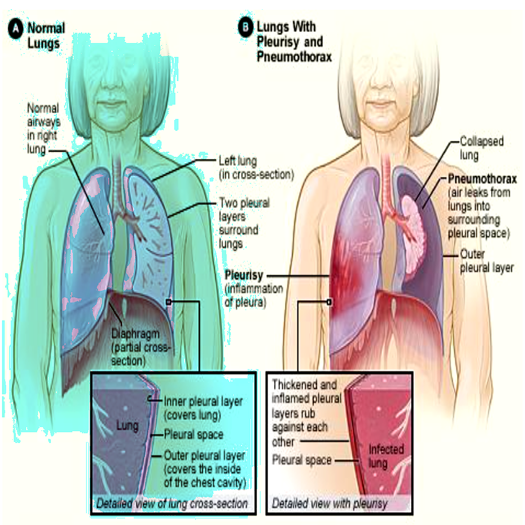 Lung Related Causes of Right Side Chest Pain