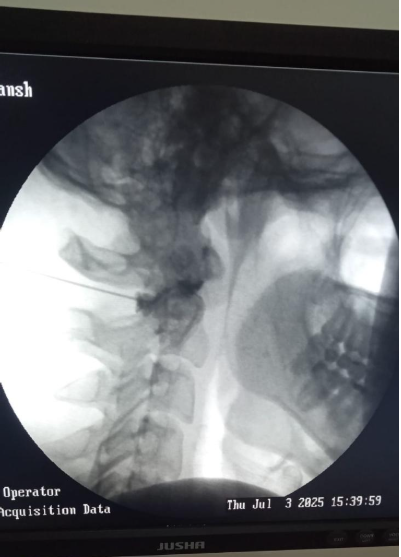 Cervical Facet Joint Injection
