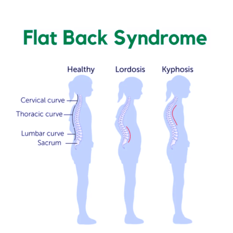 Flat Back Syndrome