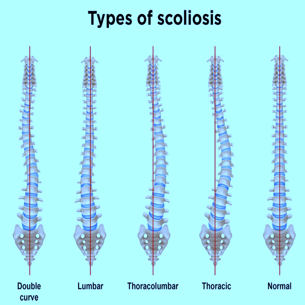 Types of Scoliosis
