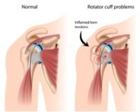 Back Pain